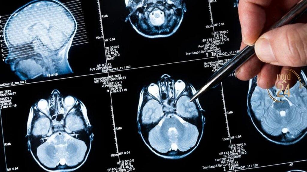 Tumores cerebrales: El dolor de cabeza no siempre es estrés