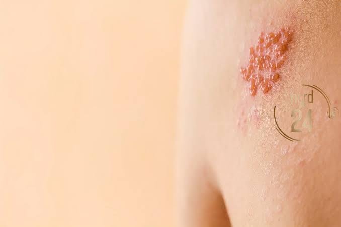 Herpes zóster: Cómo reconocer la “culebrilla” y por qué es clave actuar rápido