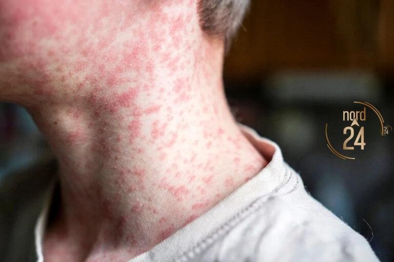 Sarampión: continua la alerta vigente a viajeros ante síntomas compatibles con la enfermedad 